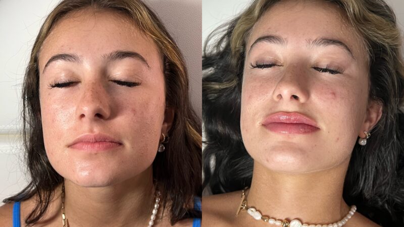 before and after filler