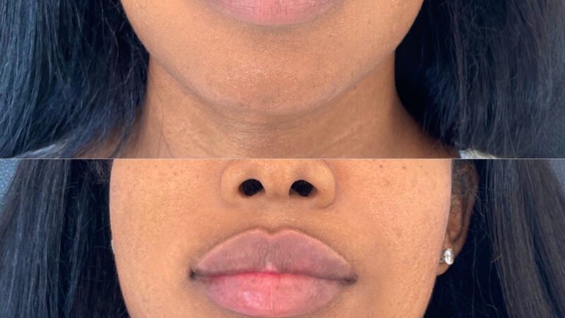 before and after