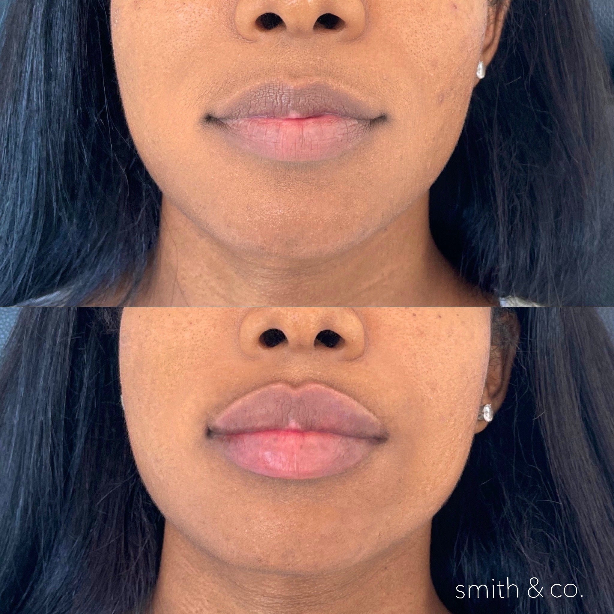 lip augmentation  before and after